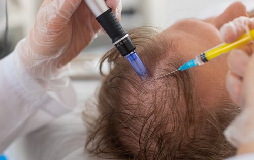 Haarausfall falsch behandelt