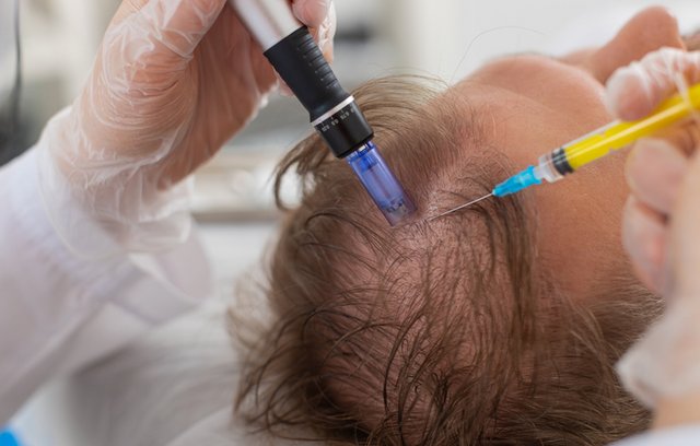 Haarausfall falsch behandelt