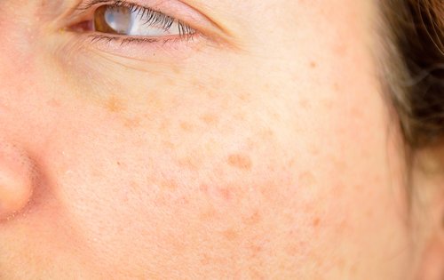 Pigmentflecken: was sie wirklich auslöst