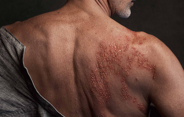 Die Symptome von Gürtelrose können von Patient:in zu Patient:in variieren.