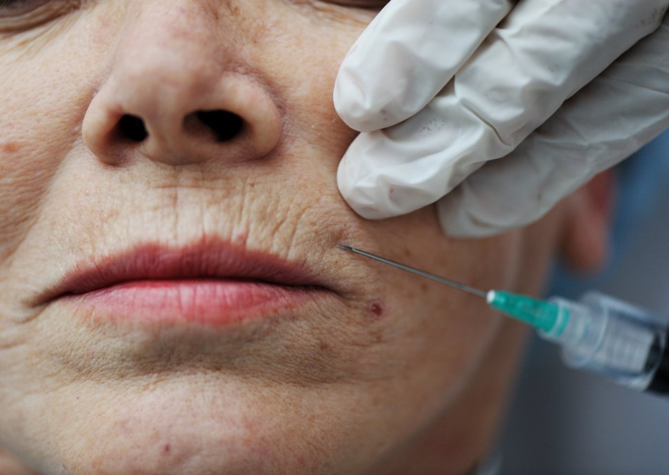 Was genau ist Botox? Was genau ist Botox?