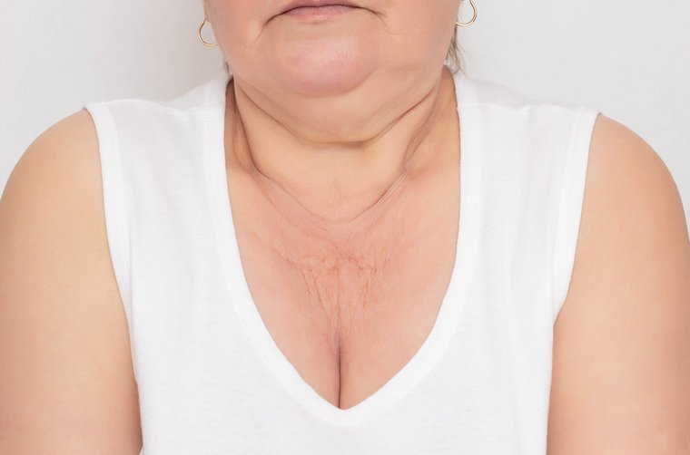 Dekolleté: Der vergessene Anti-Aging-Bereich